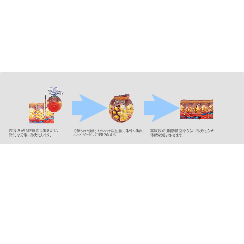 超音波による脂肪分解の仕組み
